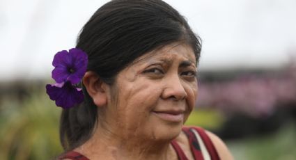 Mujeres atacadas con ácido en México: víctimas del sistema y de un Estado que las olvida
