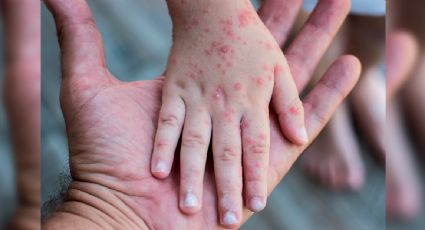 Puebla reporta más de 400 alumnos en 20 municipios con sintomas del virus Coxsackie; enfermedad que no tiene tratamiento