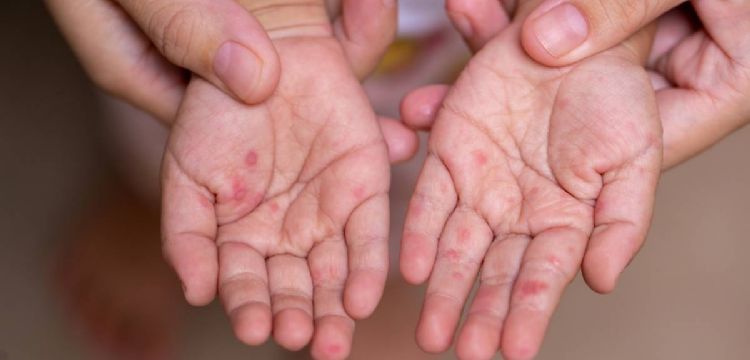 Confirman la primera muerte por sarampión en CDMX; ocurrió en 2025