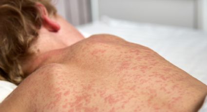 Guanajuato reporta su primer caso de sarampión tras 30 años sin contagios