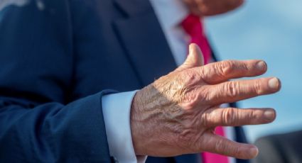 En qué consiste la insuficiencia venosa crónica que afecta a Trump