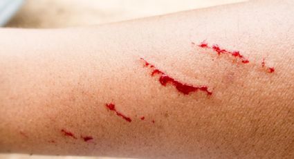 Confirman caso de rabia en humanos en Zacatecas; se trata de una menor que fue mordida por un animal silvestre