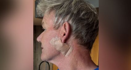 "Les prometo que no es un 'lifting' facial": el chef Gordon Ramsay se somete a una cirugía para extirpar un cáncer de piel
