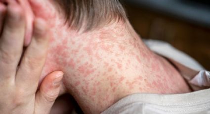 Suman más de 4 mil 350 casos de sarampión en México; van 17 muertes ligadas a la enfermedad