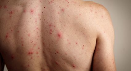 México supera los cinco mil casos confirmados de sarampión