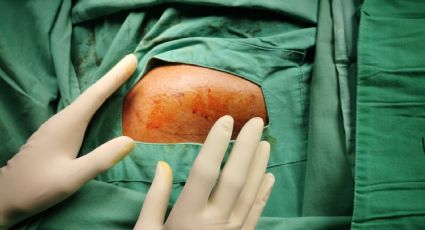 Extirpan tumor de más de 60 kilogramos a un hombre en Rusia; vivió con este más de 20 años