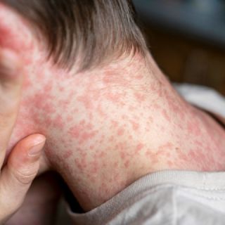 México supera a Canadá y Estados Unidos, pero en casos y muertes por sarampión