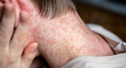 EU está cerca de perder su estatus de eliminación del sarampión por brote en cuatro estados