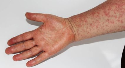 Sarampión en México: fallece niño de un año que no estaba vacunado en Tlaxcala