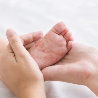 Gobierno de CDMX justifica tardanza de dos meses para confirmar la primera muerte por sarampión