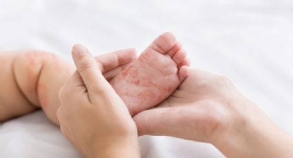 "No se certificó hasta el día de ayer": gobierno de CDMX justifica tardanza de dos meses para confirmar la primera muerte por sarampión