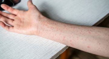 OPS emite alerta epidemiológica por sarampión; México reporta la mayoría de casos