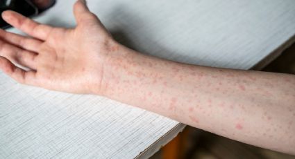 OPS emite alerta epidemiológica por sarampión; México reporta la mayoría de casos