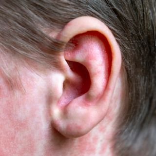 Sarampión en México: aumentan a 29 las muertes tras confirmarse primer fallecimiento en Chiapas