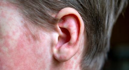 Sarampión en México: aumentan a 29 las muertes tras confirmarse primer fallecimiento en Chiapas en 2025