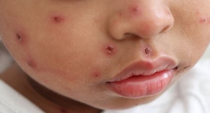 Sarampión en México: gobierno de CDMX confirma la segunda muerte a causa del virus