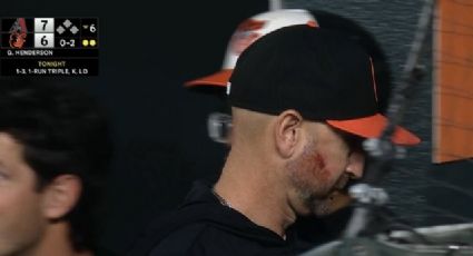 ¡Impactante! Manager de Orioles sufre siete fracturas de mejilla y una mandíbula rota tras pelotazo de uno de sus jugadores; sólo podrá comer papillas de bebé