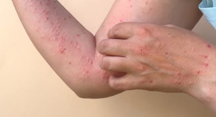 Alertan por aumento de casos de mpox en California: detectan variante más severa