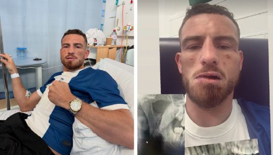 ¡Impactante! Peleador de ‘box a puño limpio’ sufre fractura de mandíbula tras cabezazo de un rival: es hospitalizado y anuncia su retiro